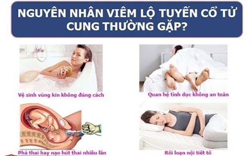 nguyên nhân gây viêm lộ tuyến