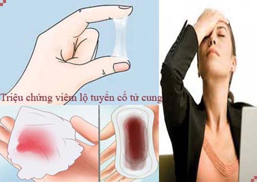 triệu chứng viêm lộ tuyến