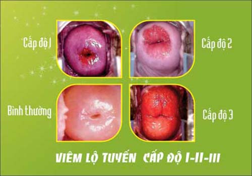 cấp độ viêm lộ tuyến