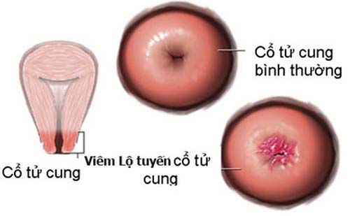 viêm lộ tuyến cổ tử cung